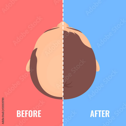 Top view portrait of a man before and after hair treatment and  transplantation. Divided image of the head on red and blue background. Two halves.  Beauty health care concept. Vector illustration.