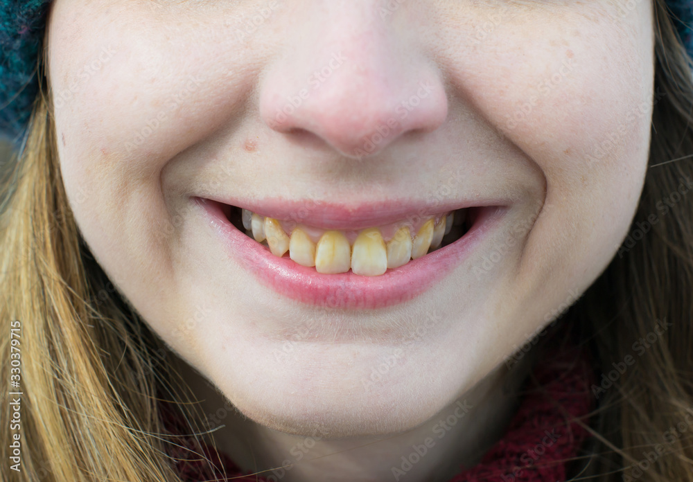 Fotografia do Stock Yellow teeth of a girl, fluorosis. Smoker's