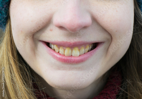 Yellow teeth of a girl, fluorosis. Smoker's problem teeth caused by fluoride, smoking, or coffee. Brown tooth enamel due to illness and drugs. Light skin and a wide smile. Natural photo