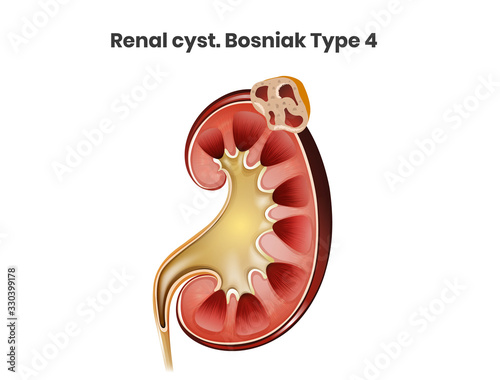 Renal cyst, Bosniak type 4. A complex cyst of the kidney. Renal cell carcinoma photo