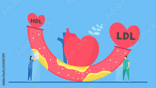 Cardiology vector illustration. This disease is narrowing of coronary arteries that caused by atherosclerosis. More cholesterol and fatty deposits. LDL value is more than HDL. photo