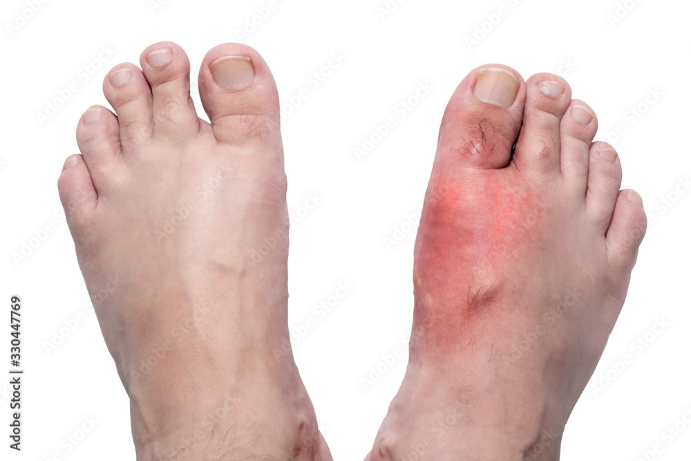 A swollen foot with large swelling due to a dislocation and a healthy foot are nearby for comparison. A swollen foot with large swelling due to a dislocation and a healthy foot are nearby for comparison.