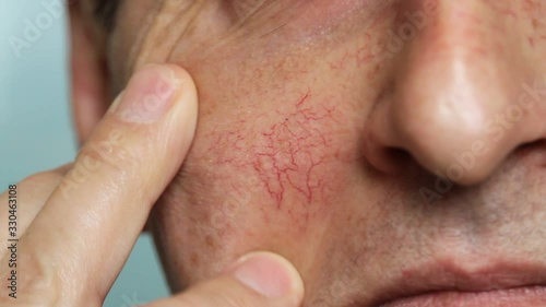 Man's face skin with vascular stars and couperose. Close up view of capillaries on the skin, telangiectasias