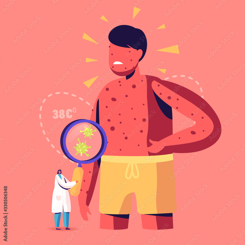 Chicken Pox Varicella Symptoms Concept. Tiny Doctor Character with  Magnifying Glass Looking on Germs at Huge Boy with Red Pimples on Body.  People Vaccination, Immunization. Cartoon Vector Illustration Stock Vector  | Adobe