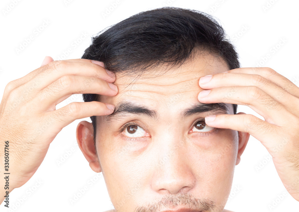 Closeup man showing wrinkles on forehead Closeup man showing wrinkles on forehead