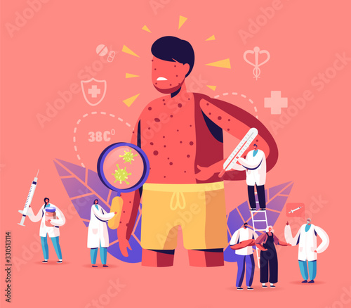 Chicken Pox Varicella Symptoms Concept. Tiny Doctors Characters with Stuff near Huge Boy with Red Pimples on Body. People Vaccination, Medical Prevention and Immunization. Cartoon Vector Illustration