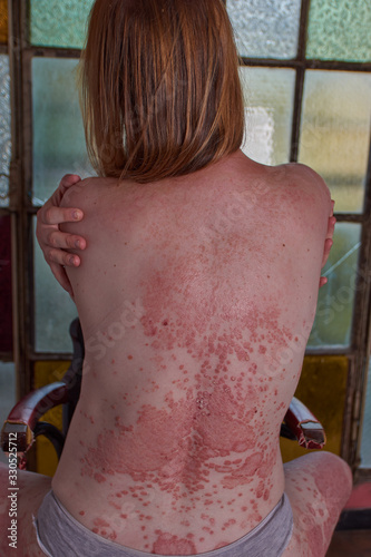 Woman's back with psoriasis