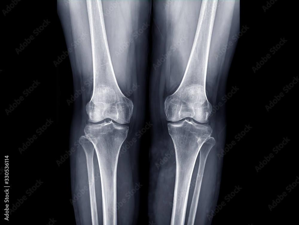 x-ray image of both knee AP view for detect Osteoarthritis Knee or OA Knee . x-ray image of both knee AP view for detect Osteoarthritis Knee or OA Knee .