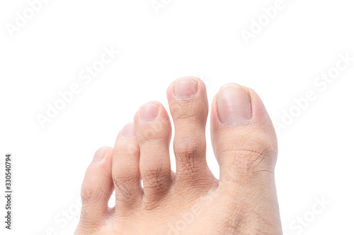 Close up of male foot and dirty long toe nail isolated on white background with clipping path. medical foot and cleanliness concept.