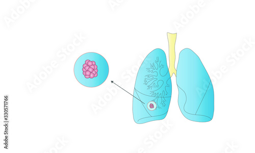 Schematic drawing of lungs with bronchi and alveoli with an enlargement of the alveoli.