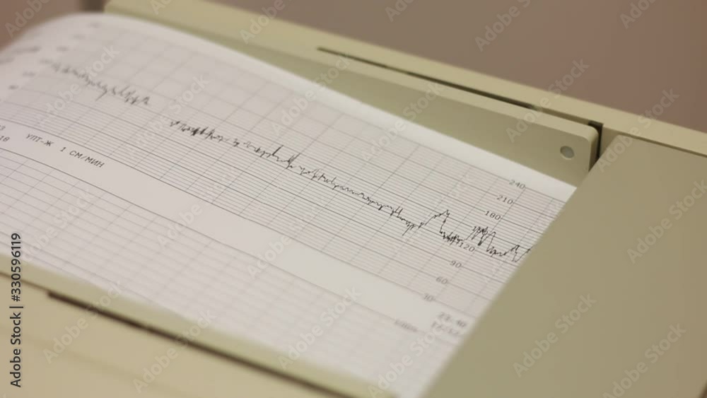 The electrocardiogram device prints a sheet with the results of the analysis The electrocardiogram device prints a sheet with the results of the analysis