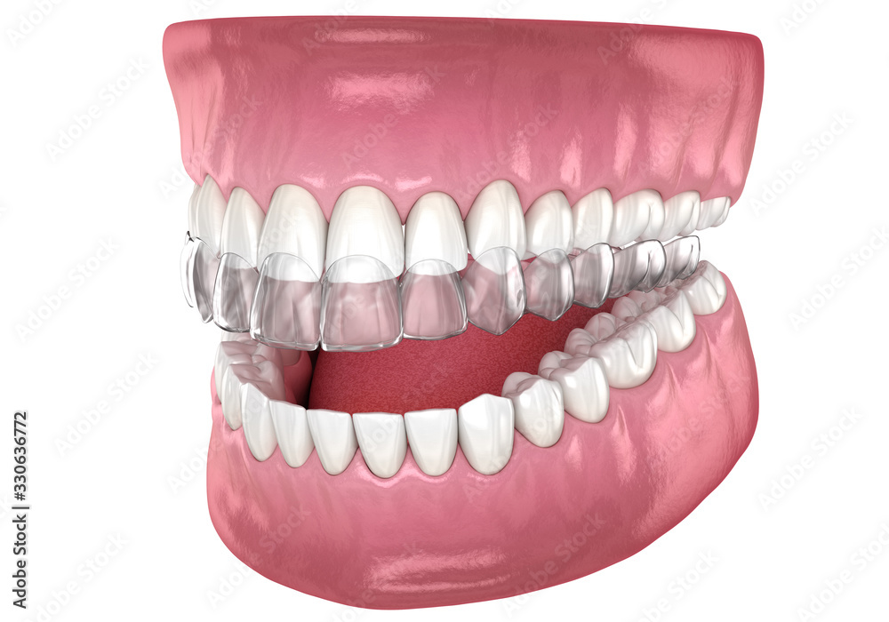 Fototapeta premium Invisalign braces or invisible retainer. Medically accurate dental 3D illustration