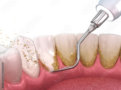 Oral hygiene: Scaling and root planing (conventional periodontal therapy). Medically accurate 3D illustration of human teeth treatment photo
