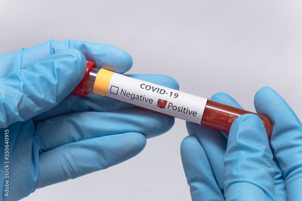 Fototapeta premium Blood positive test to coronavirus. Medical reseach, test-tube with blood, hand in latex medical gloves. Coronavirus outbreak and influenza. 2019-nCoV, covid-19, sars. High quality photo.