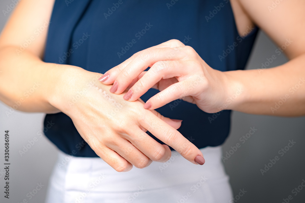 A woman applying scars removal cream to heal the first degree heat