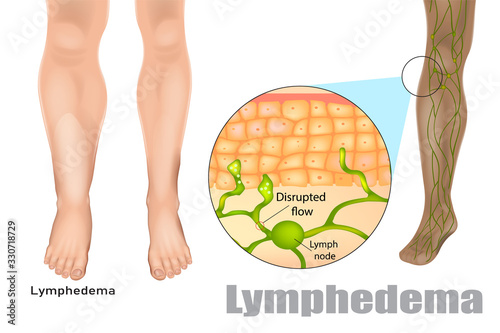 Lymphedema, also known as lymphoedema and lymphatic edema