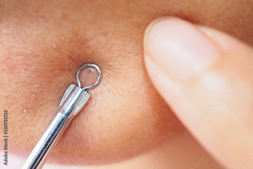 Fototapeta premium Pressing pimples , removing pimple from face, Zoom macro.