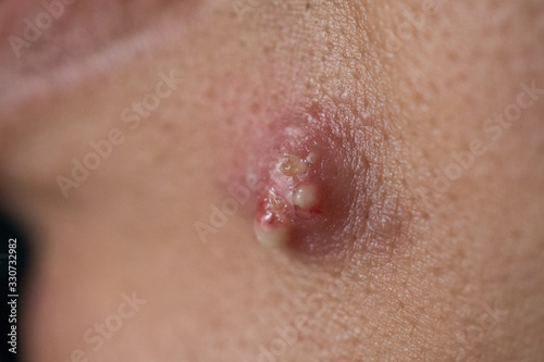 pimple extreme on human skin, large pimple, Zoom macro.