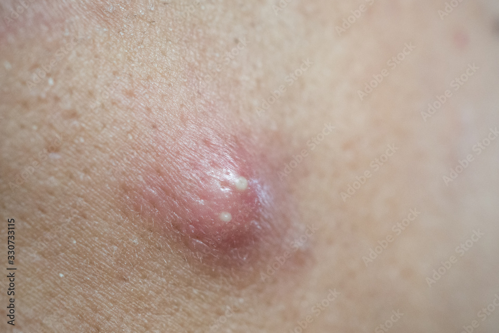 pimple extreme on human skin, large pimple, Zoom macro.