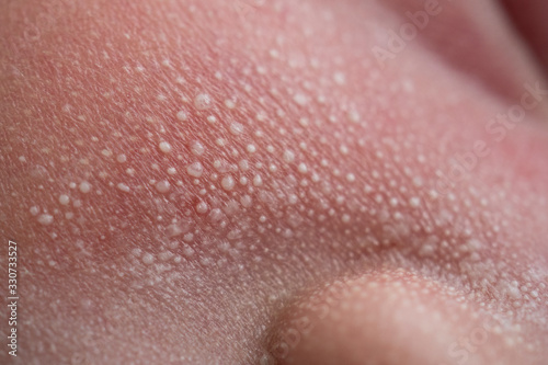 Macro, close-up shot of the milia on a two day old baby cheek, nose and forehead.
