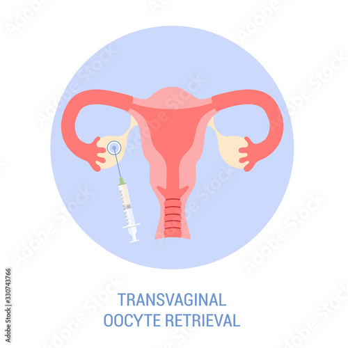 In vitro fertilisation step. Removing oocyte from the ovary