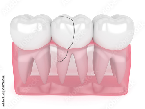 3d render of translucent gums with cracked tooth photo