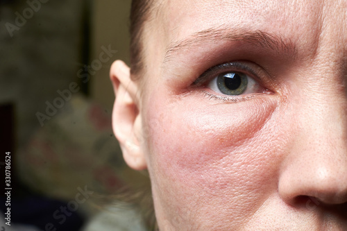 Swollen face of a woman under the eyes, swelling. An allergic reaction to drugs, cosmetics. photo