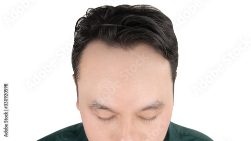Close up of Asian bald head man isolated on white background. Human hair loss problem, alopecia treatment and hair growth concept.
