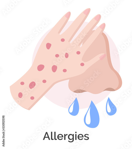 Allergies symptoms, isolated icon of allergic reaction. Sickness or illness caused by allergies. Dangerous infection, rash on hands and runny nose. Result of disease, vector in flat style illustration