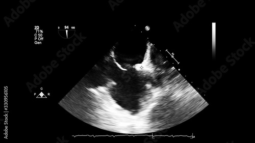 Image of the heart in gray-scale mode during transesophageal ultrasound.