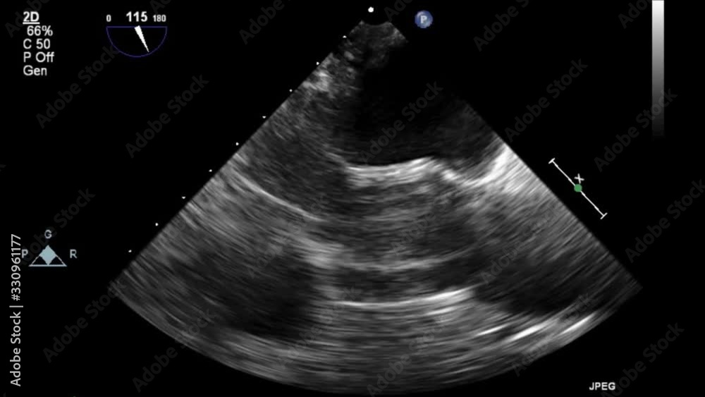 Transesophageal ultrasound video in gray-scale mode.