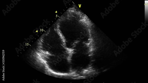 Transesophageal ultrasound video in gray-scale mode.