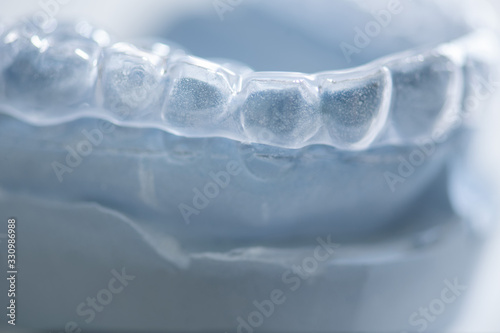 fablose Aufbissschiene gegen Zähneknirschen auf Gips Modell in der Zahnarzt Praxis