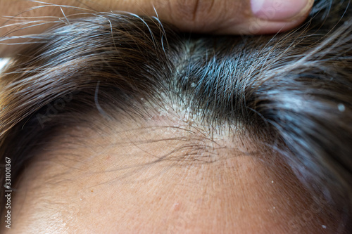 Dandruff seborrhea problem of scalp and hair treatment of peeling from allergies. Scalp dermatoses. Fatty Dandruff.