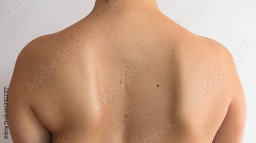 Old operation scar on the back of a young woman. Operated back. Spine surgery. Scoliosis of the spine.