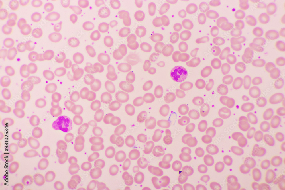 Essential thrombocytosis blood smear, present abnormal high platelet and neutrophil cell, analyze by microscope