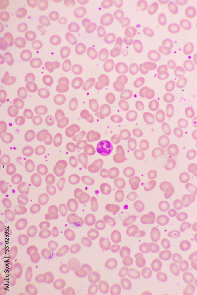 Essential thrombocytosis blood smear, present abnormal high platelet and neutrophil cell, analyze by microscope Essential thrombocytosis blood smear, present abnormal high platelet and neutrophil cell, analyze by microscope