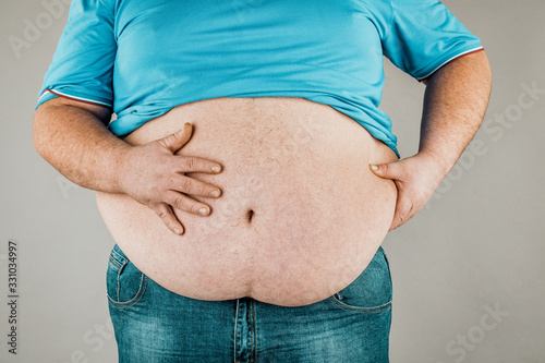 Overweight of a person's body with hands touching the abdomen. The concept of obesity