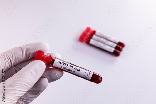 Blood samples tested for COVID-19 coronavirus - The patients tested positive for the aggressive virus. Health concept.