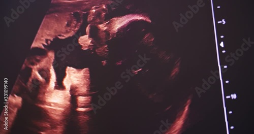 Sonography or medical ultrasound examination of a 30-week-old fetus.