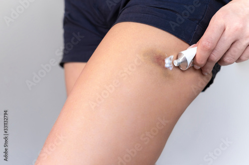 bruise on a female foot smears cream