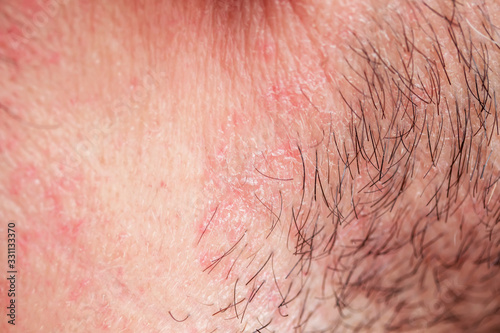  skin texture of the neck and cheeks of a young man covered with hair and beard bristles and irritation and scales
