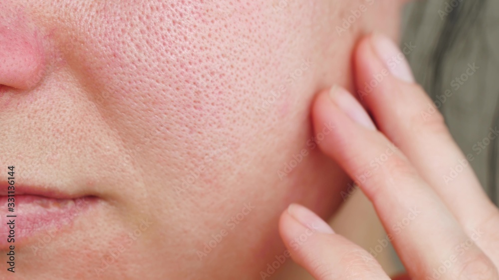 Macro skin with enlarged pores. The girl touches the irritated red skin with her fingers. Macro skin with enlarged pores. The girl touches the irritated red skin with her fingers.