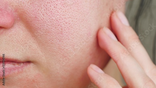 Macro skin with enlarged pores. The girl touches the irritated red skin with her fingers.