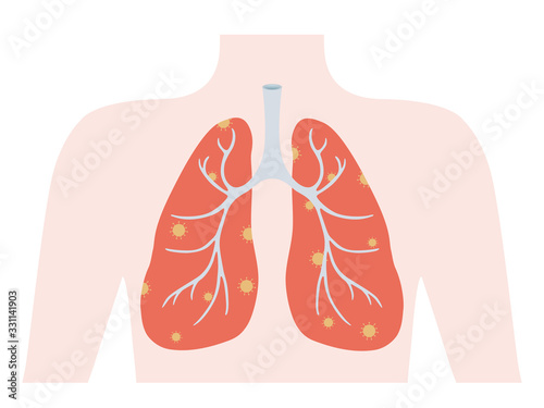 vector illustration of coronavirus-infected lungs