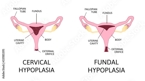 Uterine hypoplasia, naive uterus or infantile uterus.