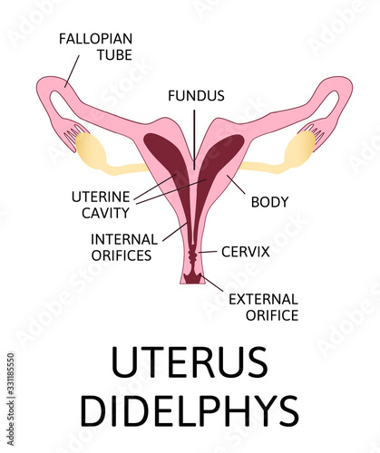 The shape of the uterus, the female reproductive organ. uterus unicornis