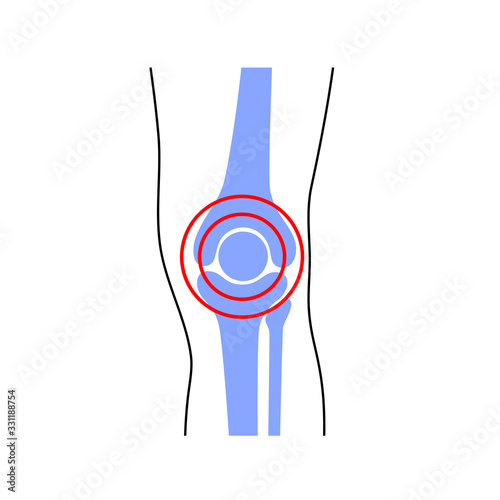 Knee joint pain