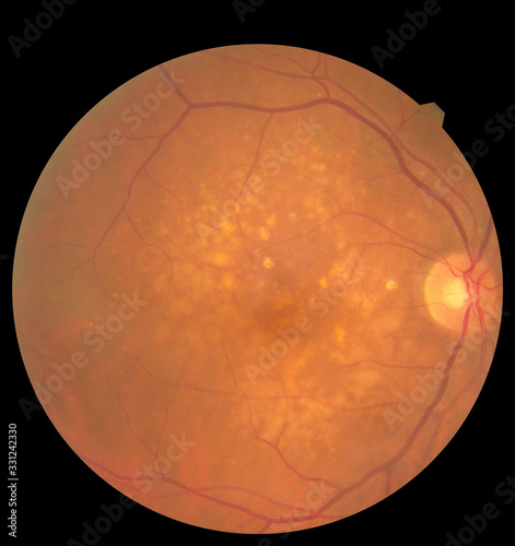 Ophthalmic image detailing the retina and optic nerve inside a healthy human eye. Health protection concept