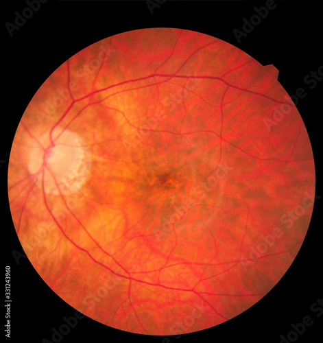 Ophthalmic image detailing the retina and optic nerve inside a healthy human eye. Medicine concept